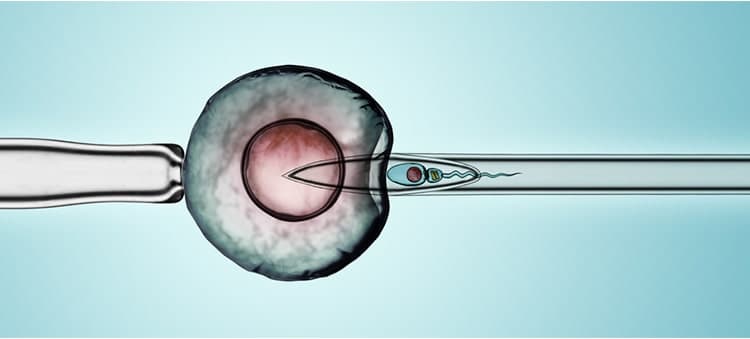 ICSI Treatment